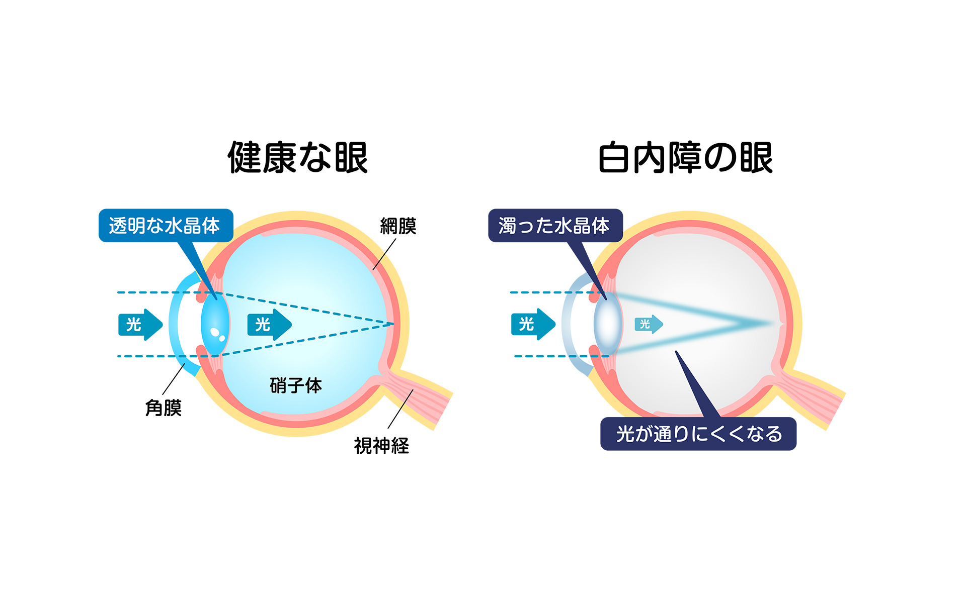 白内障のイメージ